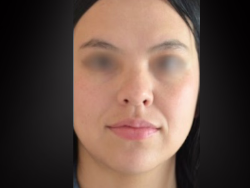 Antes del ácido hialurónico en labios: bermellón fino, arco de Cupido poco definido y labio superior corto