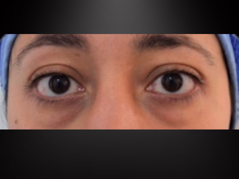 Antes del relleno de ojeras con ácido hialurónico: surco lagrimal hundido y sombra oscura bajo ambos ojos