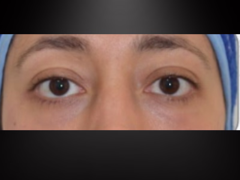 Después del ácido hialurónico en ojeras: surco lagrimal relleno y mirada descansada, tratamiento en Bogotá