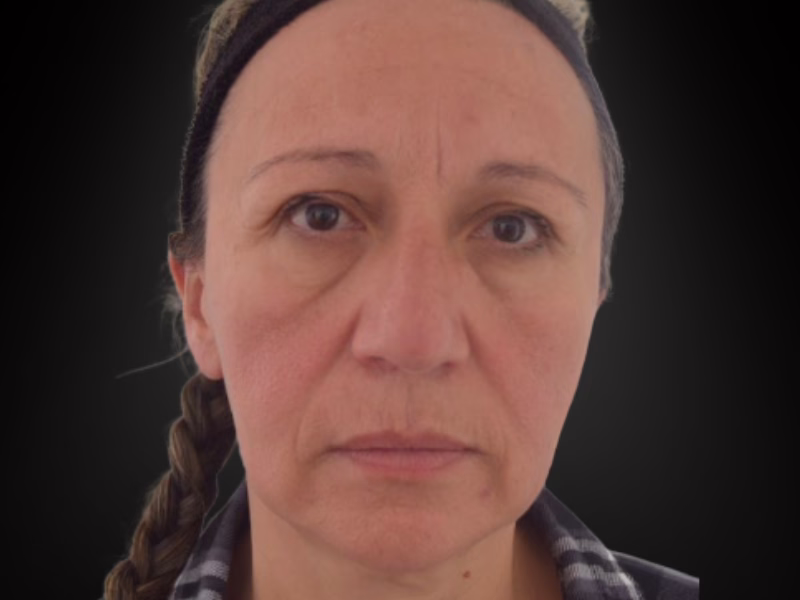 Antes del ácido hialurónico en la cara: pérdida de volumen en el tercio medio, ojeras marcadas y piel apagada
