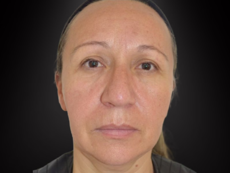 Después del ácido hialurónico facial en Bogotá: rostro con volumen restituido, mirada descansada y piel luminosa