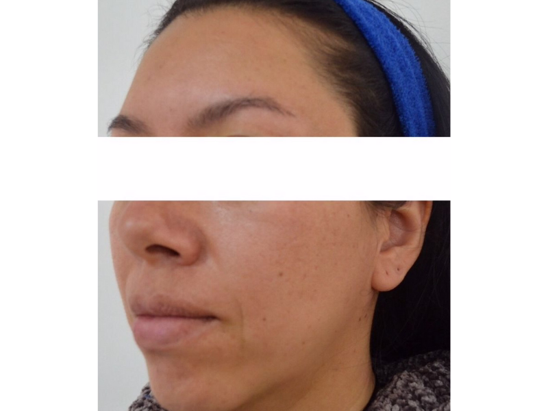  Before Complete skin revitalization 