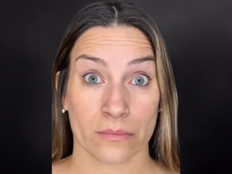 Before Wide forehead - Dysport vs Botox