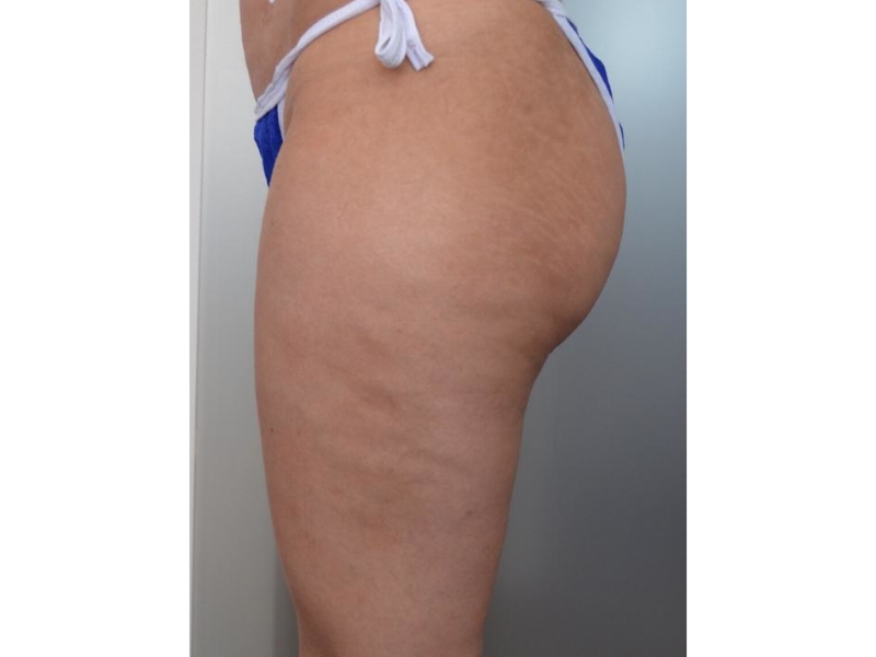  Before Lift and contour 