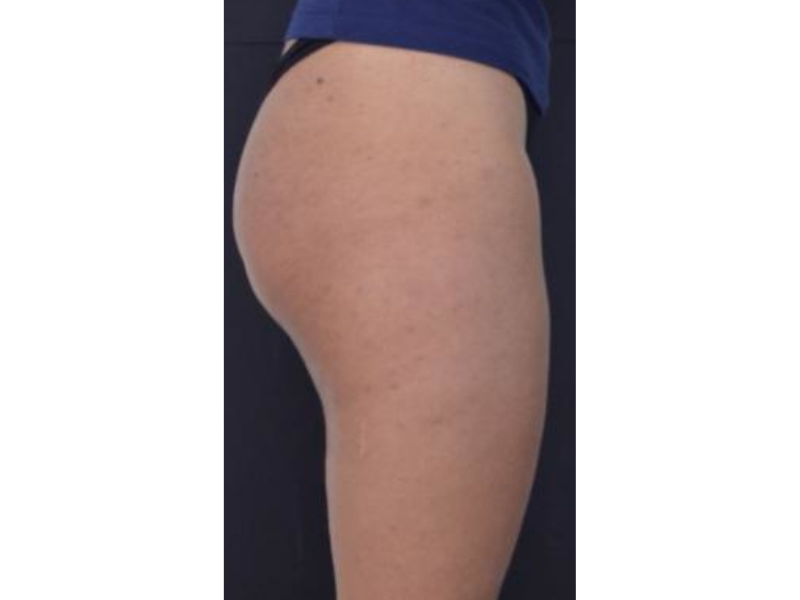  Before Lasting firmness 