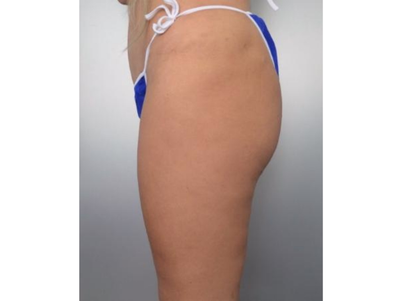  Before Complete transformation 