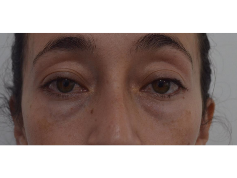 Antes del Revitalización periocular