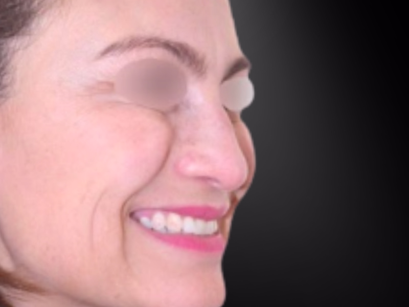 Después de la toxina botulínica: contorno de ojos y mejilla suavizados con resultado natural en piel madura, Bogotá