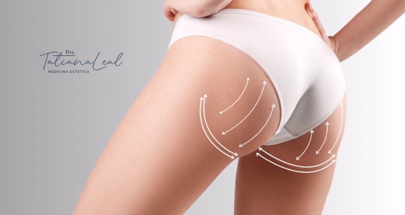 Bioestimulación de colágeno para glúteos en Colombia Bioestimulación de colágeno glúteos Sculptra Radiesse Colombia