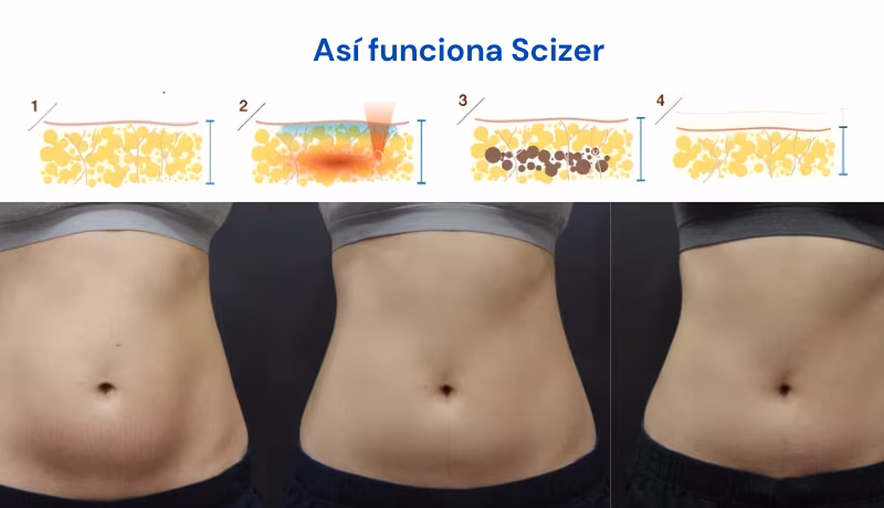 Scizer Process on Abdomen Step by step of how Scizer works on the abdomen