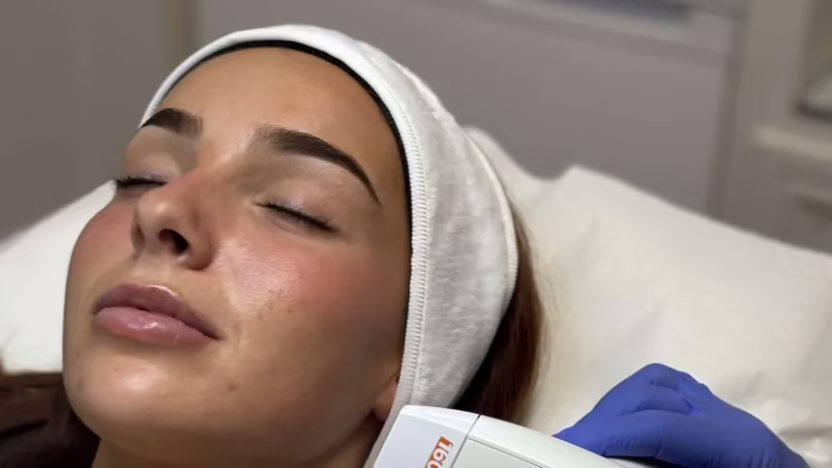 HIFU facial vs facial radiofrequency comparison Bogotá Colombia