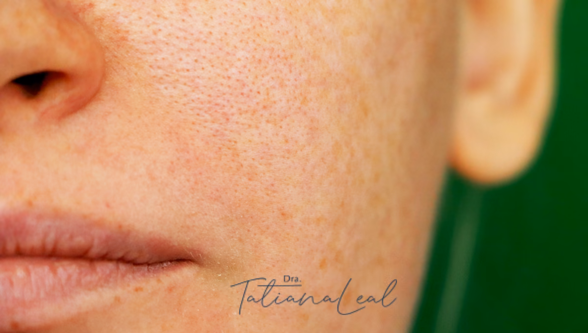 Close-up of large pores on the cheek and nose in oily skin Close-up of large pores on the cheek and nose in oily skin