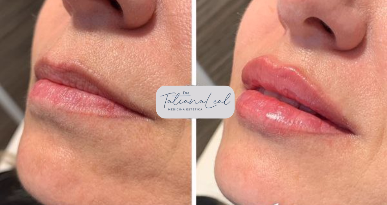 líneas de expresión boca labios tratamiento