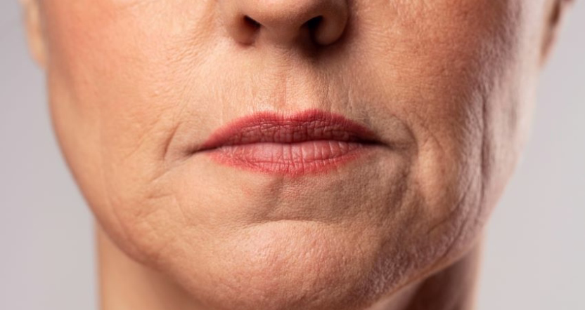 Resultados líneas de expresión ojos antes y después