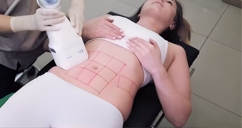 Scizer Procedure in Bogotá Application of Scizer treatment with areas in 1 session in Bogotá Colombia