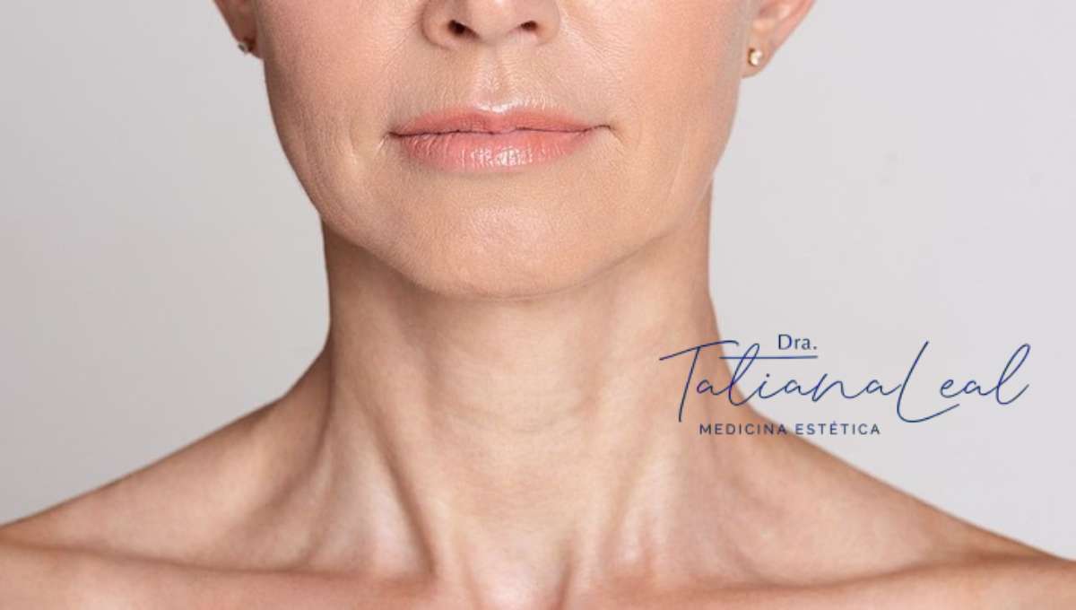 Radiesse vs hilos tensores para cuello comparativa tensado cervical sin cirugía