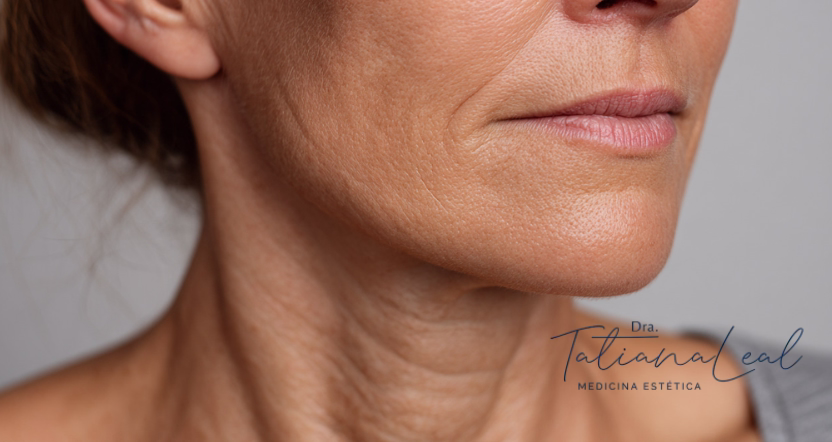 Radiesse vs hilos tensores cuello comparativa mecanismo de acción tensado cervical