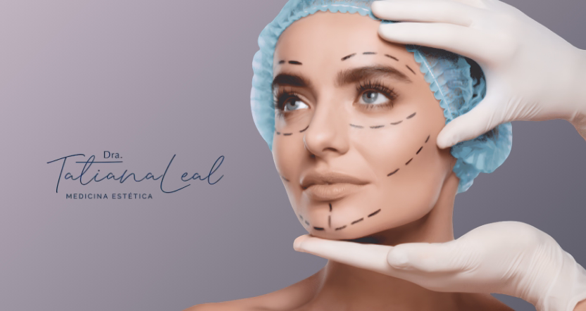 Cheeks rejuvenation with PDO thread lifts cheekbones elevation Bogotá