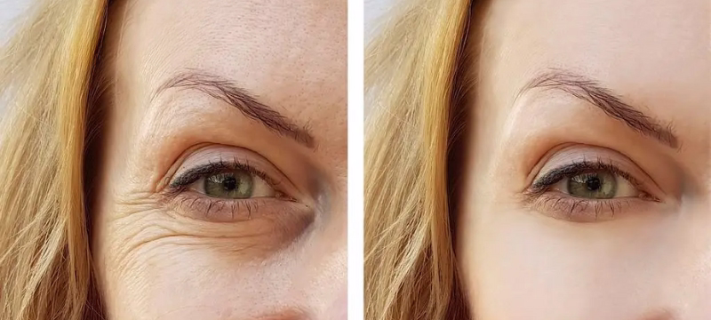 Jawline definition after Sculptra and feedback on natural results