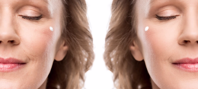 Before and after in cheeks with Sculptra and the patient's review