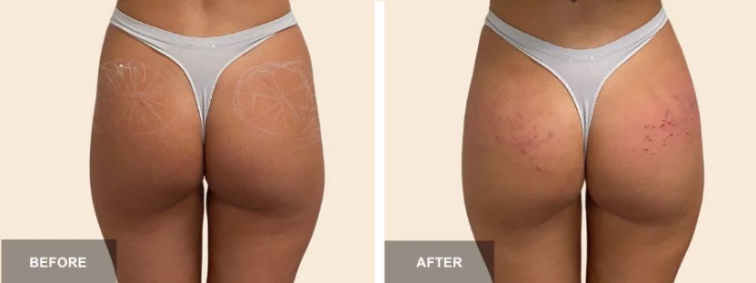 Roberto’s Bogotá case: facial asymmetry corrected with Sculptra