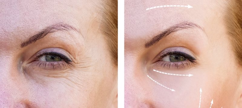 Sculptra month 1: texture, firmness, and pore improvement from collagen biostimulation