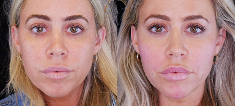 Sculptra weeks 1–2 evolution: initial swelling and even integration with the 5-5-5 protocol in Bogotá