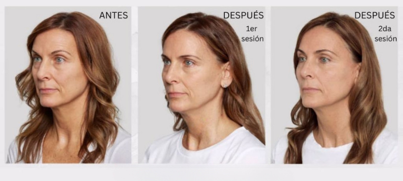 Facial Sculptra with poly-L-lactic acid to stimulate collagen
