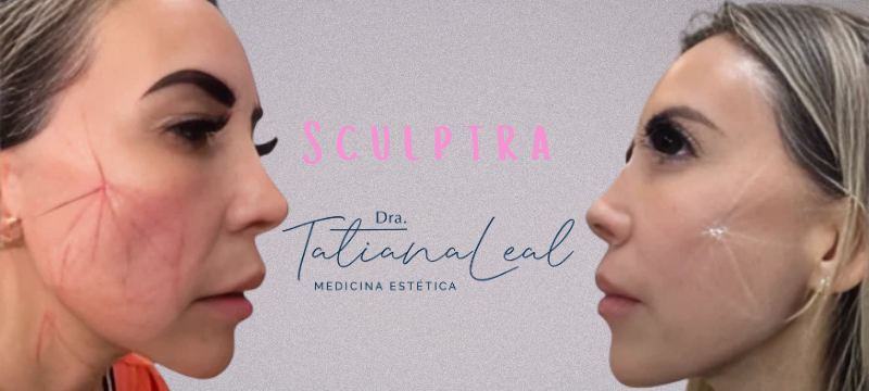 Improved jawline contour and neck firmness with facial Sculptra