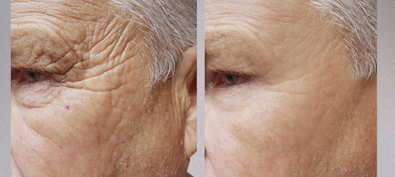 Facial Sculptra in cheeks and cheekbones to restore volume and definition