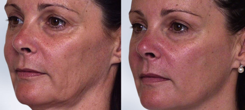 Softening nasolabial folds and marionette lines with facial Sculptra
