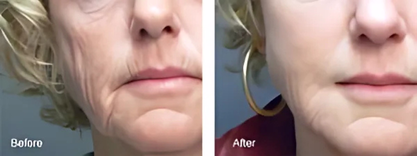 Sculptra (PLLA): bioestimulación pura y mecanismo de acción
