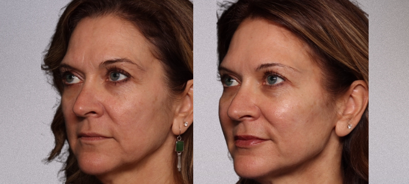 Sculptra price for buttocks in Colombia: 4–8 vials and follow-up