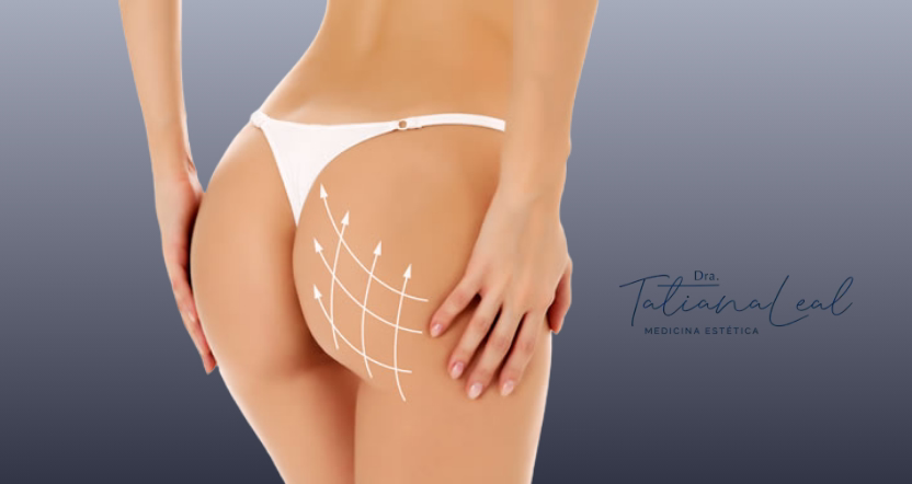 Comparación Sculptra vs Radiesse para glúteos en Bogotá Sculptra vs Radiesse bioestimuladores para glúteos Bogotá