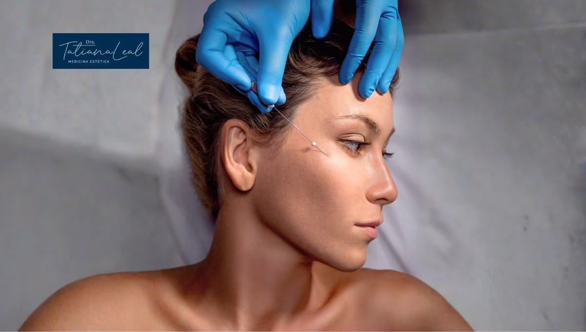 Thread Lift for Eyes and Eyelids: Non-Surgical Eye Lift