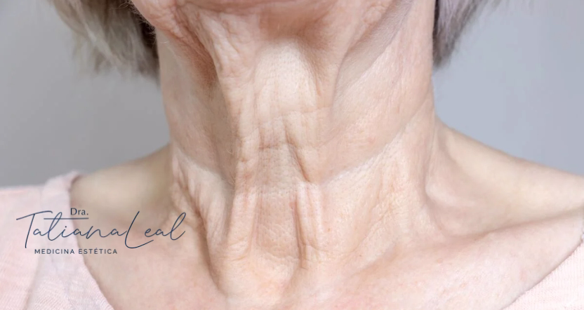 Signs of neck aging: how to classify neck flaccidity by stages Signs of neck aging classification by stages cervical laxity