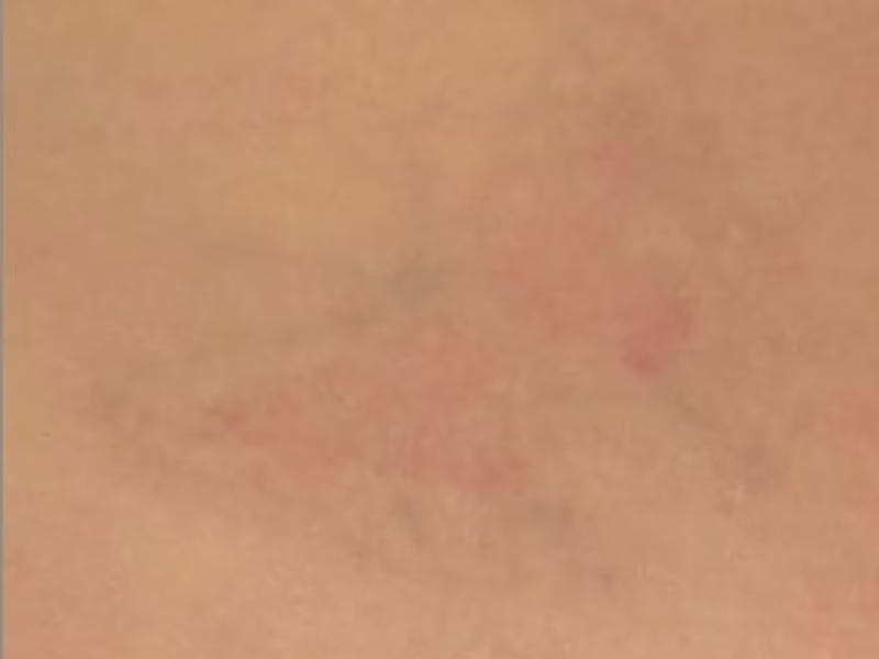 Skin after laser tattoo removal of a butterfly tattoo in Bogotá Skin after laser tattoo removal of a butterfly tattoo in Bogotá