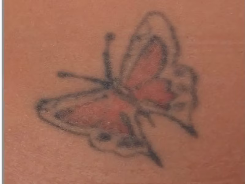 Butterfly tattoo with red and black ink before laser tattoo removal in Bogotá Butterfly tattoo with red and black ink before laser tattoo removal in Bogotá