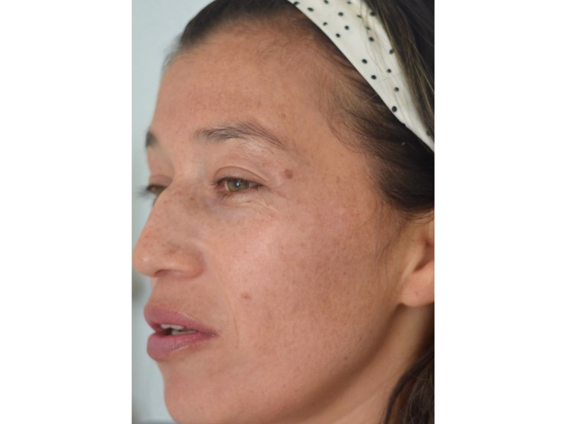 After Reduction of dark spots on the face