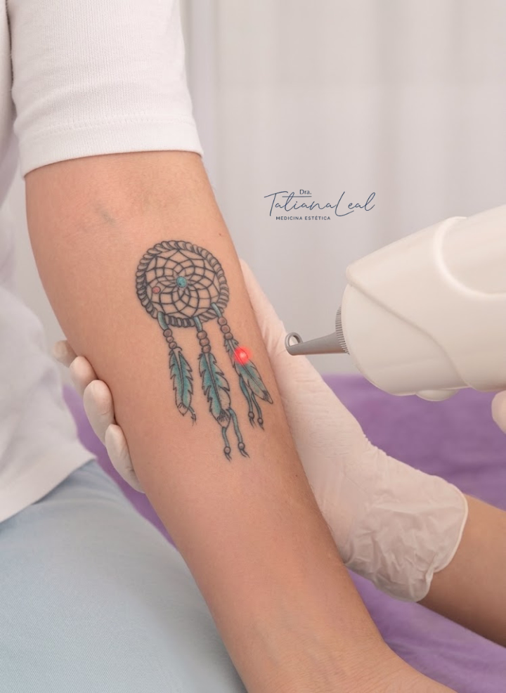 COLORMAX laser applied on an arm tattoo during a tattoo removal procedure in Bogotá Dr. Tatiana Leal applying COLORMAX laser on a tattoo during the tattoo removal procedure in Bogotá
