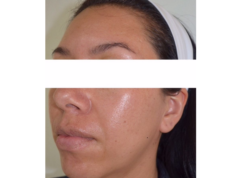 After Complete skin revitalization