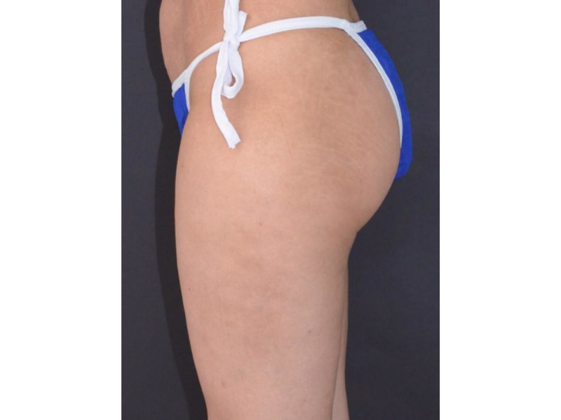 After Lift and contour