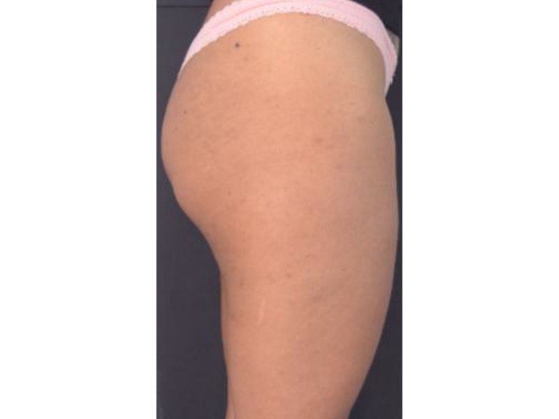 After Lasting firmness