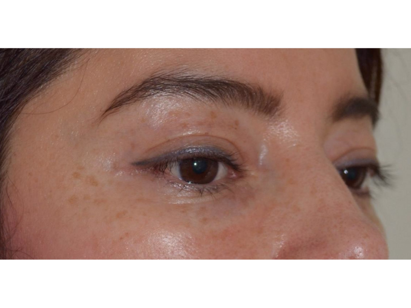Después del Rejuvenecimiento periocular