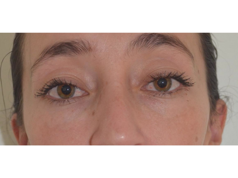 Después del Revitalización periocular