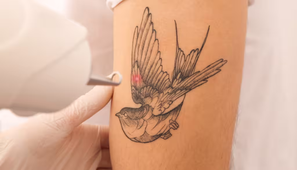 Procedimiento para borrar tatuajes con láser COLORMAX Q-SWITCHED Nd:YAG en Bogotá
