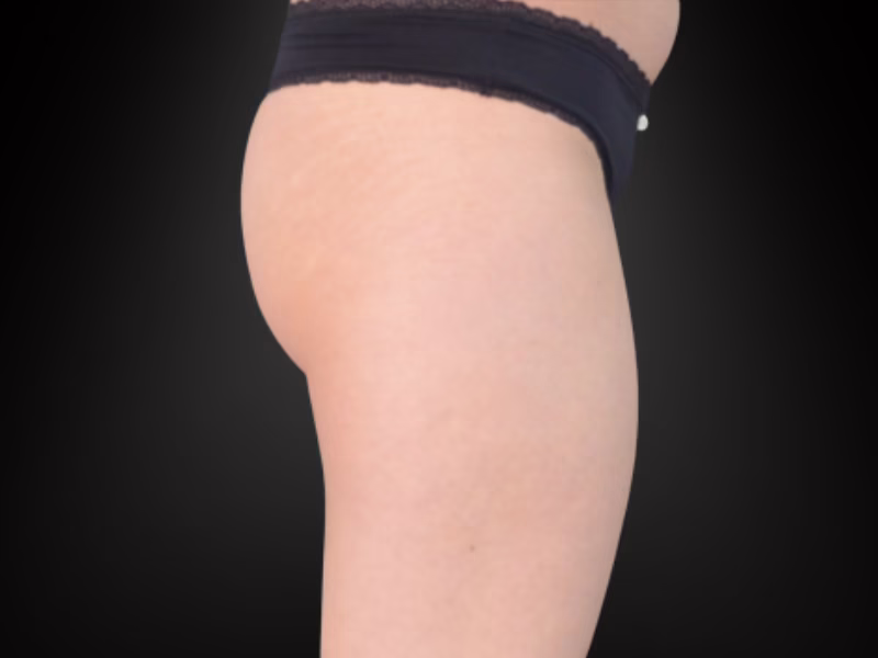 Side view of glutes after Sculptor HIFEM glute toning in Bogotá, case 1