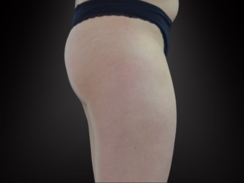 Side view of glutes before Sculptor HIFEM glute toning in Bogotá, case 1