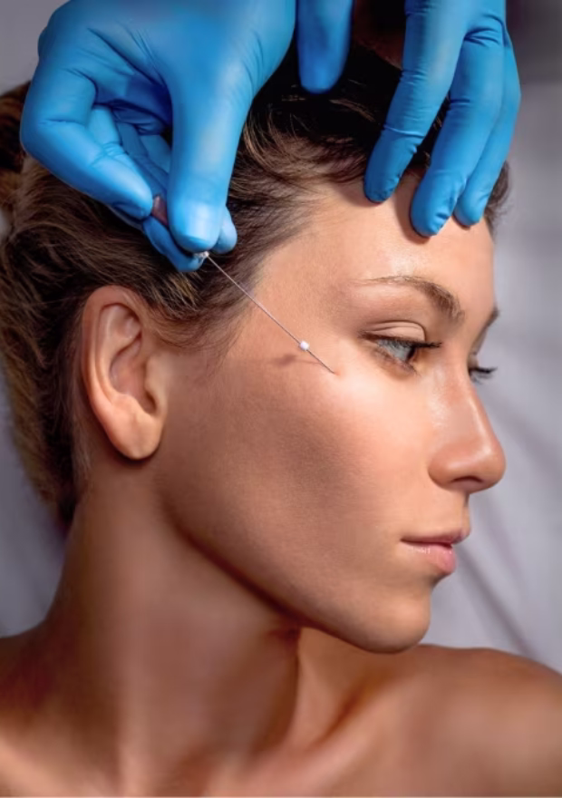 PDO thread lift application with microcannula at the temple - real procedure with Dr. Tatiana Leal in Bogotá