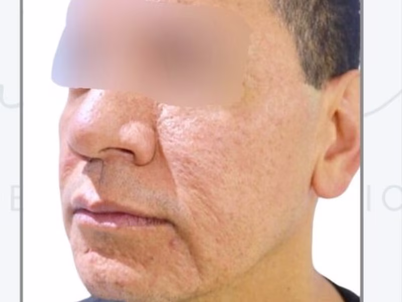 Before Definición mandibular con hilos tensores